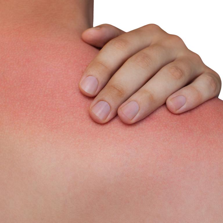 heat rash