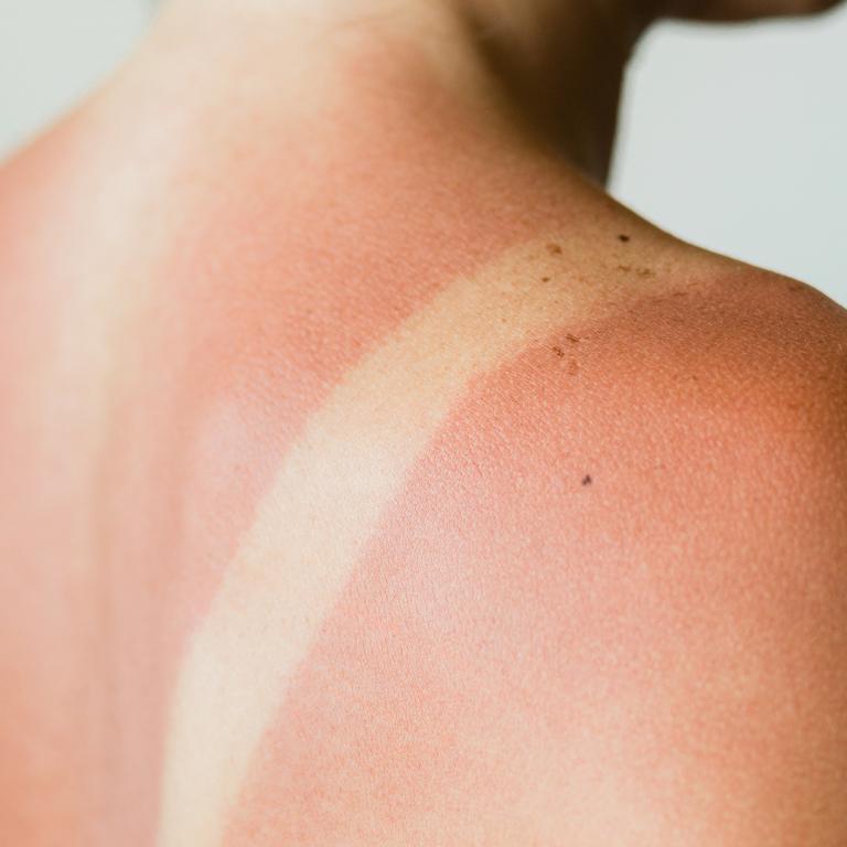 sunburn